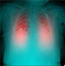 COVID-19, coronavirus, radiografías, RX, neumonía, SARS-CoV-2, IFIC, Inteligencia Artificial, Carlos III, FISABIO, UPV,